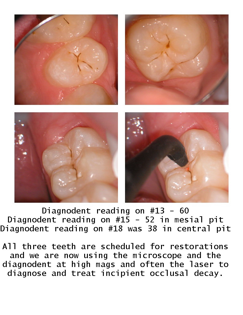 Diagnodent and Scope.jpg